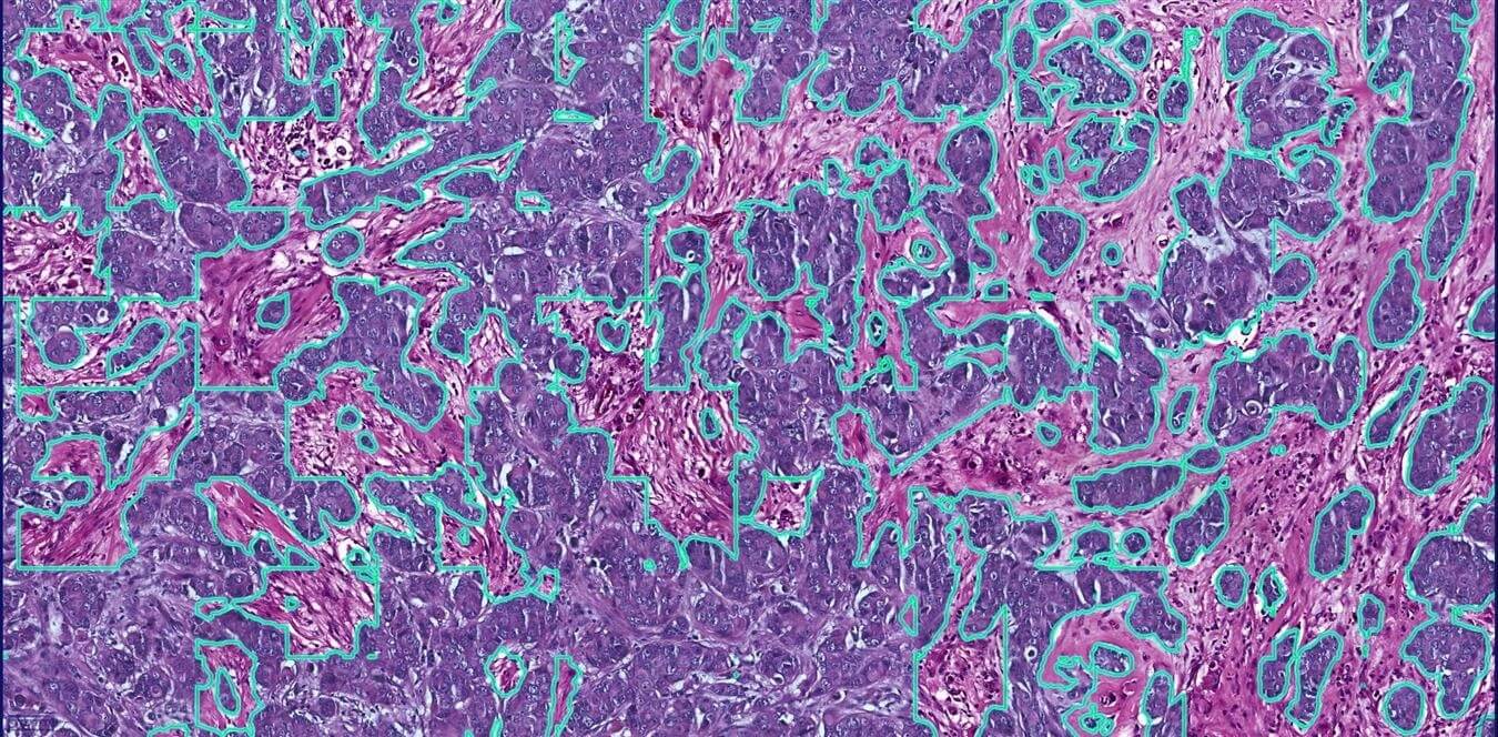 Invasive Region Detection