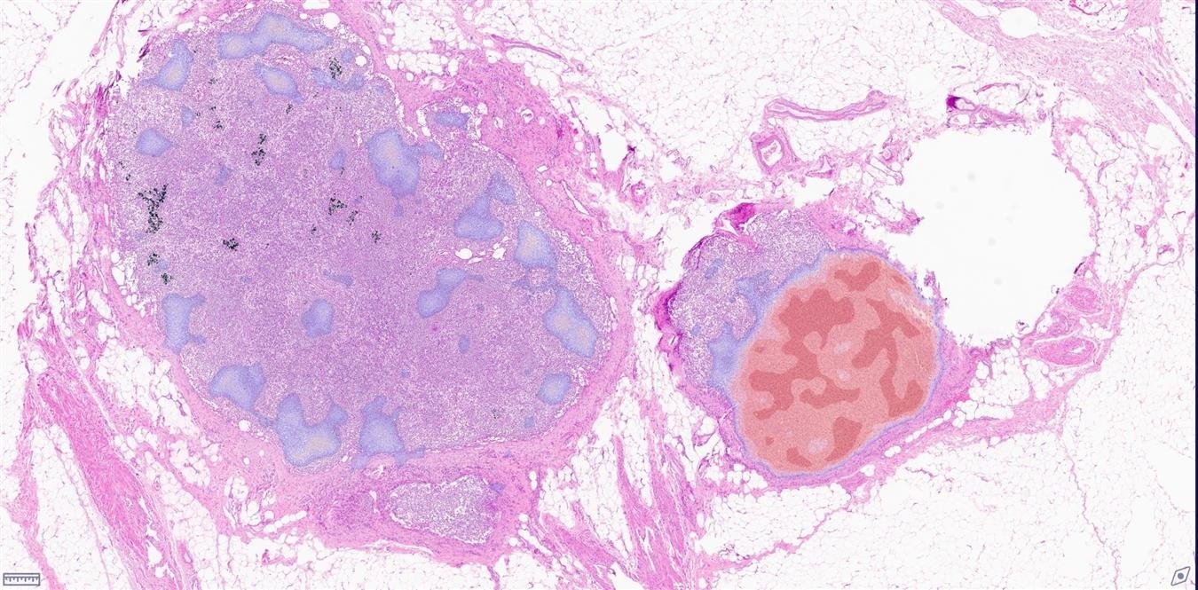 Lymph Node Metastasis