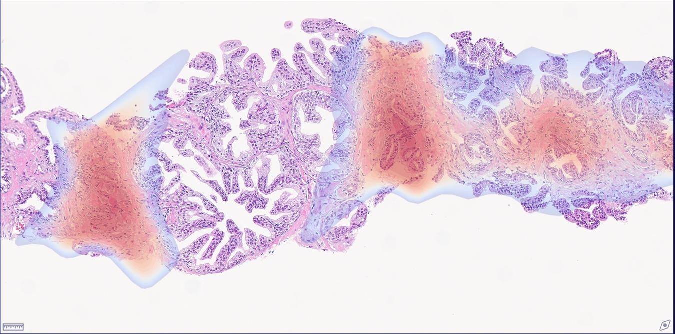 Tumor Detection