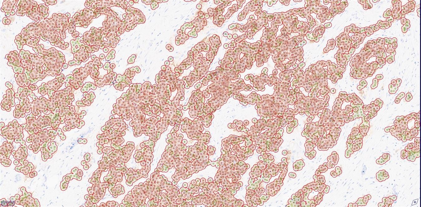 HER2 Membrane Analysis